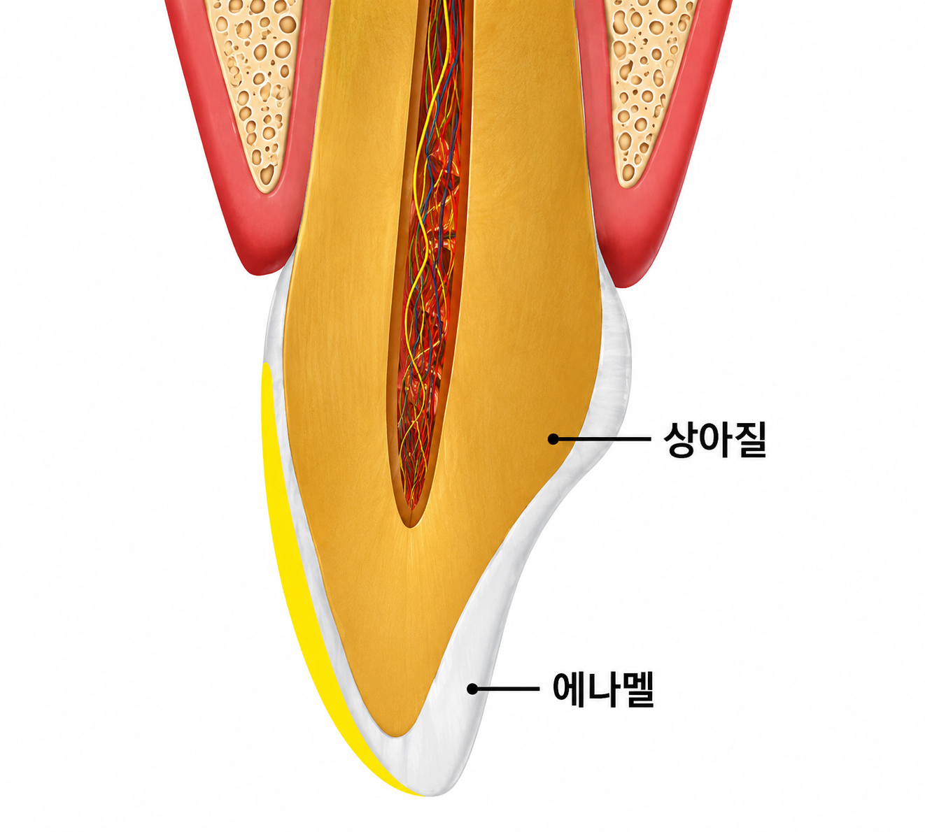 무삭제 라미네이트